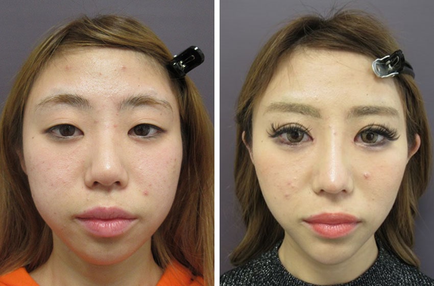 アゴ整形 銀座taクリニック ヒアルロン酸 プロテーゼ 費用 銀座のおすすめ美容整形 美容外科